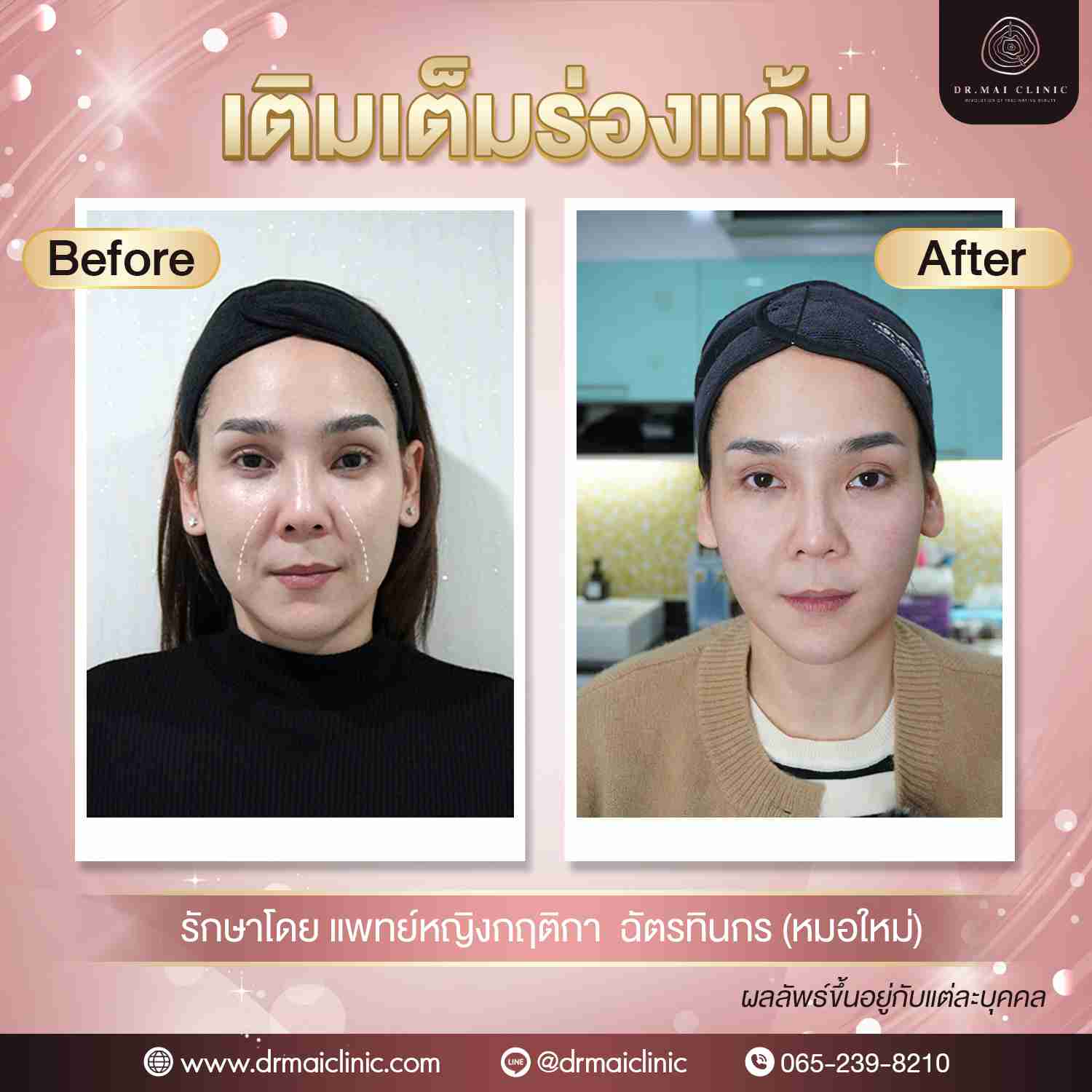 review fillerร่องแก้ม