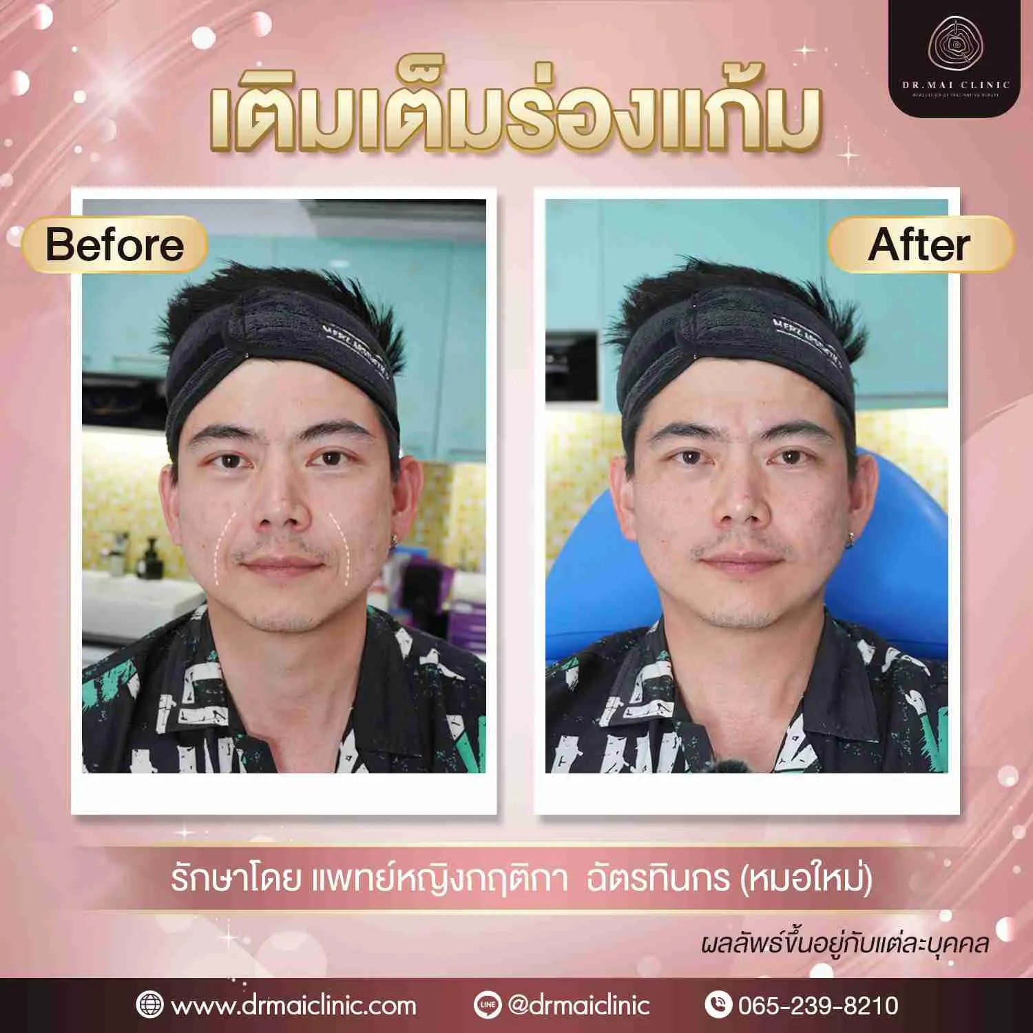 review fillerร่องแก้ม02